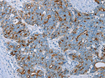 The image on the left is immunohistochemistry of paraffin-embedded Human cervical cancer tissue using MUC1 Antibody(MUC1 Antibody) at dilution 1/45, on the right is treated with synthetic peptide. (Original magnification: ×200)Rabbit anti-Human MUC1 Polyclonal Antibody