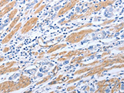 The image on the left is immunohistochemistry of paraffin-embedded Human gastric cancer tissue using GFRA4 Antibody(GFRA4 Antibody) at dilution 1/40, on the right is treated with synthetic peptide. (Original magnification: ×200)Rabbit anti-Human GFRA4 Polyclonal Antibody