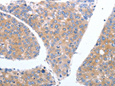 The image on the left is immunohistochemistry of paraffin-embedded Human breast cancer tissue using the antibody Antibody) at dilution 1/40, on the right is treated with synthetic peptide. (Original magnification: ×200)Rabbit anti-Human GFRA4 Polyclonal Antibody