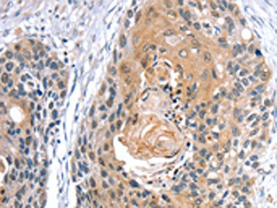The image on the left is immunohistochemistry of paraffin-embedded Human esophagus cancer tissue using GNAT3 Antibody(GNAT3 Antibody) at dilution 1/35, on the right is treated with synthetic peptide. (Original magnification: ×200)Rabbit anti-Human GNAT3 Polyclonal Antibody
