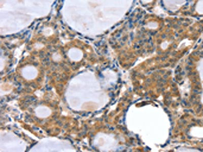 The image on the left is immunohistochemistry of paraffin-embedded Human thyroid cancer tissue using the antibody Antibody) at dilution 1/35, on the right is treated with synthetic peptide. (Original magnification: ×200)Rabbit anti-Human GNAT3 Polyclonal Antibody