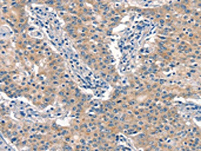 The image on the left is immunohistochemistry of paraffin-embedded Human gastric cancer tissue using EID3 Antibody(EID3 Antibody) at dilution 1/15, on the right is treated with synthetic peptide. (Original magnification: ×200)Rabbit anti-Human EID3 Polyclonal Antibody