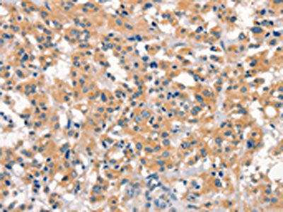 The image on the left is immunohistochemistry of paraffin-embedded Human thyroid cancer tissue using the antibody Antibody) at dilution 1/15, on the right is treated with synthetic peptide. (Original magnification: ×200)Rabbit anti-Human EID3 Polyclonal Antibody