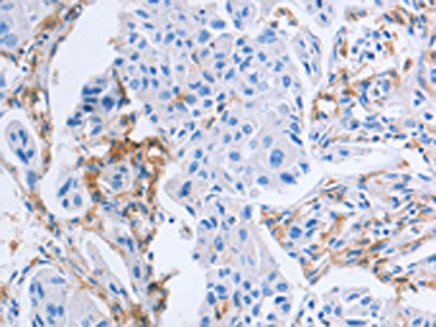 The image on the left is immunohistochemistry of paraffin-embedded Human breast cancer tissue using LAIR1 Antibody(LAIR1 Antibody) at dilution 1/25, on the right is treated with fusion protein. (Original magnification: ×200)