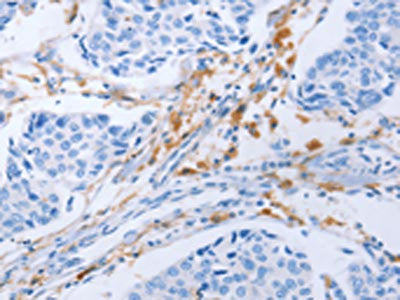 The image on the left is immunohistochemistry of paraffin-embedded Human lung cancer tissue using the antibody Antibody) at dilution 1/25, on the right is treated with fusion protein. (Original magnification: ×200)