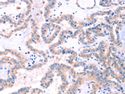 The image on the left is immunohistochemistry of paraffin-embedded Human thyroid cancer tissue using STXBP2 Antibody(STXBP2 Antibody) at dilution 1/20, on the right is treated with fusion protein. (Original magnification: ×200)Rabbit anti-Human STXBP2 Polyclonal Antibody