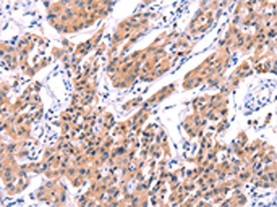 The image on the left is immunohistochemistry of paraffin-embedded Human lung cancer tissue using the antibody Antibody) at dilution 1/20, on the right is treated with fusion protein. (Original magnification: ×200)Rabbit anti-Human STXBP2 Polyclonal Antibody