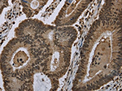 The image on the left is immunohistochemistry of paraffin-embedded Human colon cancer tissue using the antibody Antibody) at dilution 1/40, on the right is treated with fusion protein. (Original magnification: ×200)Rabbit anti-Human HIST1H2AH Polyclonal Antibody