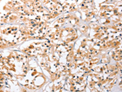 The image on the left is immunohistochemistry of paraffin-embedded Human thyroid cancer tissue using HDAC8 Antibody(HDAC8 Antibody) at dilution 1/40, on the right is treated with fusion protein. (Original magnification: ×200)Rabbit anti-Human HDAC8 Polyclonal Antibody