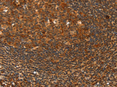 The image on the left is immunohistochemistry of paraffin-embedded Human tonsil tissue using the antibody Antibody) at dilution 1/40, on the right is treated with fusion protein. (Original magnification: ×200)Rabbit anti-Human HDAC8 Polyclonal Antibody