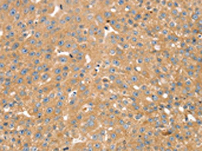 The image on the left is immunohistochemistry of paraffin-embedded Human breast cancer tissue using SNX2 Antibody(SNX2 Antibody) at dilution 1/40, on the right is treated with synthetic peptide. (Original magnification: ×200)Rabbit anti-Human SNX2 Polyclonal Antibody