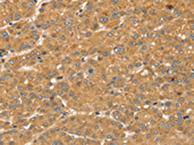 The image on the left is immunohistochemistry of paraffin-embedded Human liver cancer tissue using the antibody Antibody) at dilution 1/40, on the right is treated with synthetic peptide. (Original magnification: ×200)Rabbit anti-Human SNX2 Polyclonal Antibody