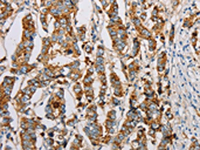 The image on the left is immunohistochemistry of paraffin-embedded Human breast cancer tissue using IFITM3 Antibody(IFITM3 Antibody) at dilution 1/20, on the right is treated with fusion protein. (Original magnification: ×200)Rabbit anti-Human IFITM3 Polyclonal Antibody