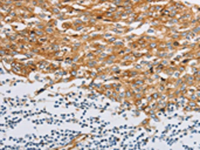The image on the left is immunohistochemistry of paraffin-embedded Human esophagus cancer tissue using the antibody Antibody) at dilution 1/20, on the right is treated with fusion protein. (Original magnification: ×200)Rabbit anti-Human IFITM3 Polyclonal Antibody