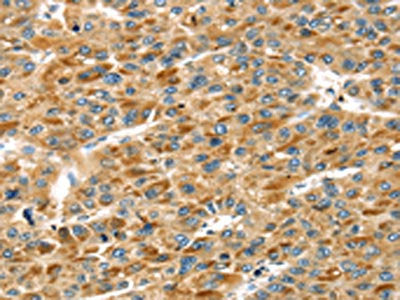 The image on the left is immunohistochemistry of paraffin-embedded Human liver cancer tissue using STX11 Antibody(STX11 Antibody) at dilution 1/30, on the right is treated with fusion protein. (Original magnification: ×200)Rabbit anti-Human STX11 Polyclonal Antibody