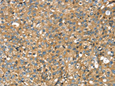 The image on the left is immunohistochemistry of paraffin-embedded Human breast cancer tissue using the antibody Antibody) at dilution 1/30, on the right is treated with fusion protein. (Original magnification: ×200)Rabbit anti-Human STX11 Polyclonal Antibody
