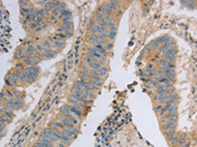 The image on the left is immunohistochemistry of paraffin-embedded Human colon cancer tissue using MAGED1 Antibody(MAGED1 Antibody) at dilution 1/30, on the right is treated with fusion protein. (Original magnification: ×200)