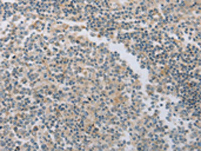 The image on the left is immunohistochemistry of paraffin-embedded Human tonsil tissue using the antibody Antibody) at dilution 1/30, on the right is treated with fusion protein. (Original magnification: ×200)