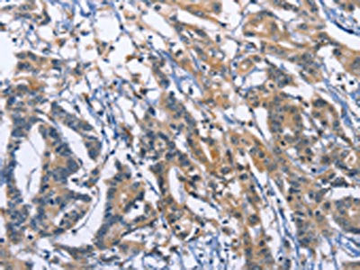 The image on the left is immunohistochemistry of paraffin-embedded Human colon cancer tissue using SYT17 Antibody(SYT17 Antibody) at dilution 1/60, on the right is treated with fusion protein. (Original magnification: ×200)Rabbit anti-Human SYT17 Polyclonal Antibody