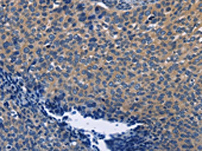 The image on the left is immunohistochemistry of paraffin-embedded Human cervical cancer tissue using the antibody Antibody) at dilution 1/60, on the right is treated with fusion protein. (Original magnification: ×200)Rabbit anti-Human SYT17 Polyclonal Antibody