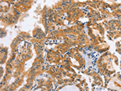 The image on the left is immunohistochemistry of paraffin-embedded Human thyroid cancer tissue using DDX58 Antibody(DDX58 Antibody) at dilution 1/70, on the right is treated with synthetic peptide. (Original magnification: ×200)Rabbit anti-Human DDX58 Polyclonal Antibody