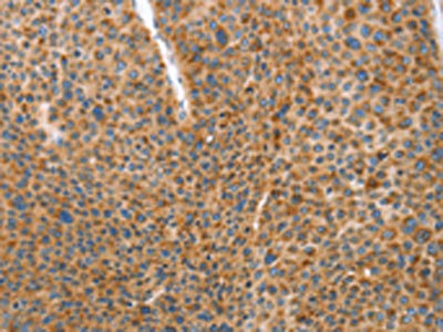 The image on the left is immunohistochemistry of paraffin-embedded Human liver cancer tissue using the antibody Antibody) at dilution 1/70, on the right is treated with synthetic peptide. (Original magnification: ×200)Rabbit anti-Human DDX58 Polyclonal Antibody