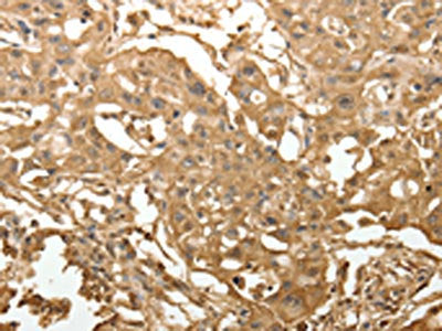 The image on the left is immunohistochemistry of paraffin-embedded Human lung cancer tissue using TXN Antibody(TXN Antibody) at dilution 1/40, on the right is treated with synthetic peptide. (Original magnification: ×200)Rabbit anti-Human TXN Polyclonal Antibody