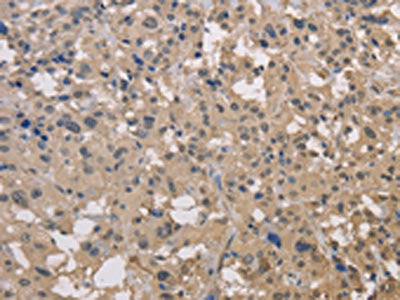 The image on the left is immunohistochemistry of paraffin-embedded Human thyroid cancer tissue using the antibody Antibody) at dilution 1/30, on the right is treated with fusion protein. (Original magnification: ×200)Rabbit anti-Human DRG1 Polyclonal Antibody