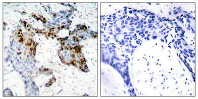 Immunohistochemical analysis of paraffin-embedded human breast carcinoma tissue using Estrogen Receptor-a(Ab-118) Antibody(left) or the same antibody preincubated with blocking peptide(right).Rabbit anti-Human ESR1 Polyclonal Antibody