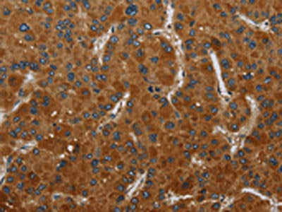 The image on the left is immunohistochemistry of paraffin-embedded Human liver cancer tissue using the antibody Antibody) at dilution 1/50, on the right is treated with fusion protein. (Original magnification: ×200)Rabbit anti-Human CSH1 Polyclonal Antibody