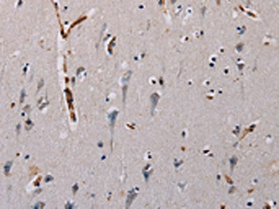 The image on the left is immunohistochemistry of paraffin-embedded Human brain  tissue using PLCB3 Antibody(PLCB3 Antibody) at dilution 1/40, on the right is treated with synthetic peptide. (Original magnification: ×200)Rabbit anti-Human PLCB3 Polyclonal Antibody