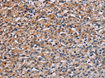The image on the left is immunohistochemistry of paraffin-embedded Human prostate cancer tissue using the antibody Antibody) at dilution 1/40, on the right is treated with synthetic peptide. (Original magnification: ×200)Rabbit anti-Human PLCB3 Polyclonal Antibody