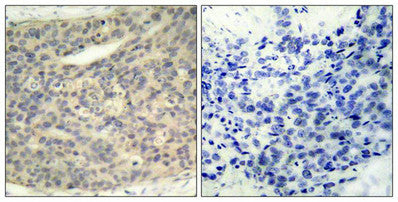 Immunohistochemical analysis of paraffin-embedded human breast carcinoma tissue using LIMK1(Phospho-Thr508) Antibody(left) or the same antibody preincubated with blocking peptide(right).