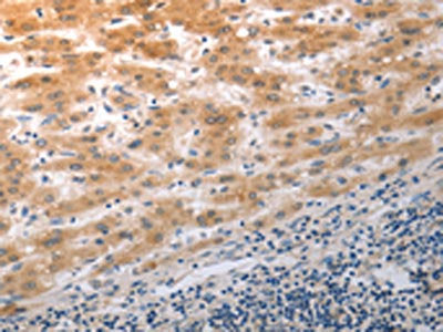 The image on the left is immunohistochemistry of paraffin-embedded Human liver cancer tissue using NQO2 Antibody(NQO2 Antibody) at dilution 1/50, on the right is treated with synthetic peptide. (Original magnification: ×200)Rabbit anti-Human NQO2 Polyclonal Antibody