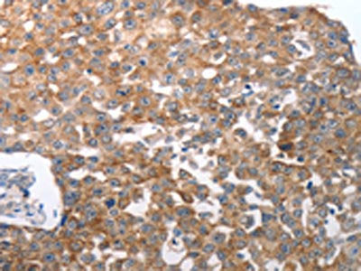 The image on the left is immunohistochemistry of paraffin-embedded Human breast cancer tissue using the antibody Antibody) at dilution 1/50, on the right is treated with synthetic peptide. (Original magnification: ×200)Rabbit anti-Human NQO2 Polyclonal Antibody