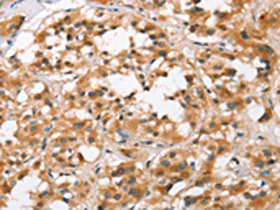 The image on the left is immunohistochemistry of paraffin-embedded Human thyroid cancer tissue using BCAS4 Antibody(BCAS4 Antibody) at dilution 1/50, on the right is treated with synthetic peptide. (Original magnification: ×200)