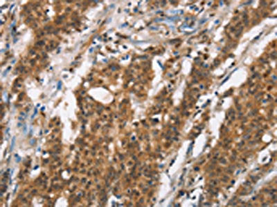The image on the left is immunohistochemistry of paraffin-embedded Human gastic cancer tissue using the antibody Antibody) at dilution 1/50, on the right is treated with synthetic peptide. (Original magnification: ×200)