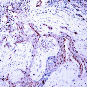 Immunohistochemical analysis of paraffin-embedded human breast carcinoma tissue using Progesterone Receptor(Phospho-Ser190) Antibody.Rabbit anti-Human PGR Polyclonal Antibody