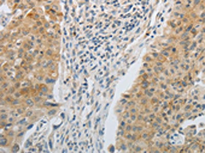 The image on the left is immunohistochemistry of paraffin-embedded Human lung cancer tissue using TGFB1 Antibody(TGFB1 Antibody) at dilution 1/25, on the right is treated with fusion protein. (Original magnification: X200)Rabbit anti-Human TGFB1 Polyclonal Antibody