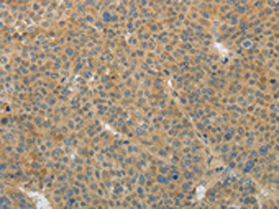 The image on the left is immunohistochemistry of paraffin-embedded Human liver cancer tissue using the antibody Antibody) at dilution 1/25, on the right is treated with fusion protein. (Original magnification: X200)Rabbit anti-Human TGFB1 Polyclonal Antibody