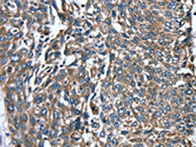 The image on the left is immunohistochemistry of paraffin-embedded Human lung cancer tissue using PTRH2 Antibody(PTRH2 Antibody) at dilution 1/20, on the right is treated with fusion protein. (Original magnification: ×200)Rabbit anti-Human PTRH2 Polyclonal Antibody