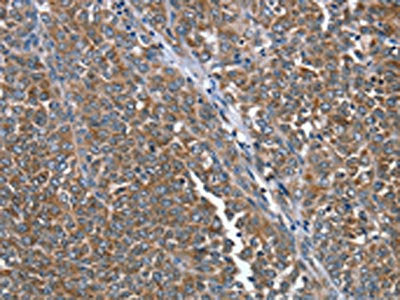The image on the left is immunohistochemistry of paraffin-embedded Human ovarian cancer tissue using the antibody Antibody) at dilution 1/20, on the right is treated with fusion protein. (Original magnification: ×200)Rabbit anti-Human PTRH2 Polyclonal Antibody