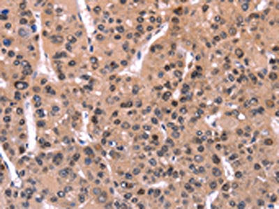 The image on the left is immunohistochemistry of paraffin-embedded Human liver cancer tissue using ARC Antibody(ARC Antibody) at dilution 1/50, on the right is treated with fusion protein. (Original magnification: ×200)Rabbit anti-Human ARC Polyclonal Antibody