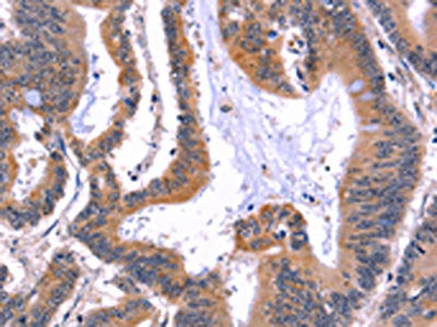 The image on the left is immunohistochemistry of paraffin-embedded Human colon cancer tissue using the antibody Antibody) at dilution 1/50, on the right is treated with fusion protein. (Original magnification: ×200)Rabbit anti-Human ARC Polyclonal Antibody