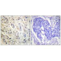 Immunohistochemistry analysis of paraffin-embedded human colon carcinoma tissue using p90 RSK (Ab-573) antibody.Rabbit anti-Human RPS6KA1 Polyclonal Antibody