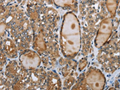 The image on the left is immunohistochemistry of paraffin-embedded Human thyroid cancer tissue using GGT1 Antibody(GGT1 Antibody) at dilution 1/40, on the right is treated with fusion protein. (Original magnification: ×200)Rabbit anti-Human GGT1 Polyclonal Antibody