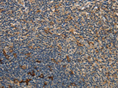 The image on the left is immunohistochemistry of paraffin-embedded Human tonsil tissue using the antibody Antibody) at dilution 1/40, on the right is treated with fusion protein. (Original magnification: ×200)Rabbit anti-Human GGT1 Polyclonal Antibody