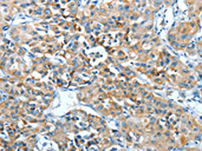 The image on the left is immunohistochemistry of paraffin-embedded Human lung cancer tissue using ADRA1B Antibody(ADRA1B Antibody) at dilution 1/25, on the right is treated with synthetic peptide. (Original magnification: ×200)Rabbit anti-Human ADRA1B Polyclonal Antibody