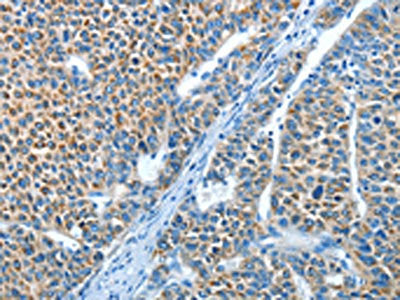 The image on the left is immunohistochemistry of paraffin-embedded Human liver cancer tissue using the antibody Antibody) at dilution 1/25, on the right is treated with synthetic peptide. (Original magnification: ×200)