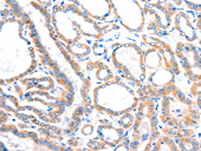 The image on the left is immunohistochemistry of paraffin-embedded Human thyroid cancer tissue using VANGL1 Antibody(VANGL1 Antibody) at dilution 1/20, on the right is treated with fusion protein. (Original magnification: ×200)Rabbit anti-Human VANGL1 Polyclonal Antibody
